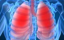 Yếu tố quyết định sự sống còn của người ung thư phổi