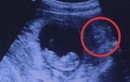 Giật mình mặt quỷ xuất hiện trong hình siêu âm thai nhi
