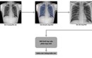 VinBrain phát hành sách trắng về ứng dụng AI chẩn đoán bệnh lao