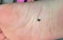'Nốt ruồi' này trên cơ thể đứa trẻ có nghĩa là 'may mắn' 