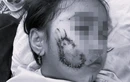 Bị chó cắn, bé gái 5 tuổi ở Quảng Bình phải khâu 50 mũi