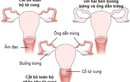 Cắt tử cung có ảnh hưởng chuyện phòng the?