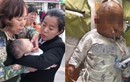 Bị táo rơi trúng đầu, bé gái 3 tháng tuổi chấn thương sọ não vĩnh viễn