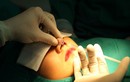 Tiêm filler nâng mũi, một phụ nữ ở TP HCM có thể múc bỏ mắt