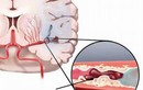 Cách điều trị thiếu máu não hiệu quả