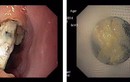 Bác sĩ hết hồn gắp cục pin rỉ trong thực quản cháu bé