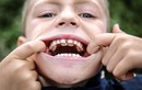Cậu bé có hai hàng răng như cá mập