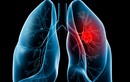 Ung thư phổi ở đàn ông và đàn bà khác nhau thế nào?