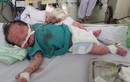 Cứu sống bé sơ sinh bị thủy đậu chứng xuất huyết phổi