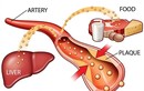 Tại sao rối loạn lipid máu nguy hiểm? 