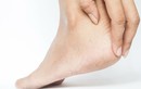 Nguyên nhân hàng đầu khiến gót chân dễ bị nứt nẻ