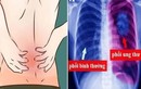 Ðau lưng phía sau phổi có phải dấu hiệu ung thư?