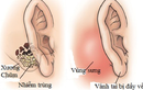 Tai có mùi hôi thối - triệu chứng của nhiều bệnh lý nguy hiểm