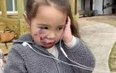 Câu nói của bé gái 3 tuổi sau trận tấn công của chó pit bull
