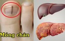 4 dấu hiệu ở bàn chân cảnh báo chức năng gan suy giảm