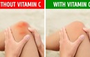 5 dấu hiệu cho thấy cơ thể đang thiếu vitamin C cần bổ sung ngay