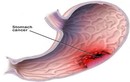 Thực phẩm gây ung thư dạ dày cao lại được nhiều người mê đắm