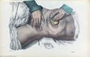 Ám ảnh những ca phẫu thuật không gây mê thế kỷ 19