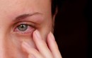 Dịch đau mắt đỏ lây nhanh trong trường: Phòng bệnh thế nào?