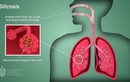 Bệnh bụi phổi silic gây tử vong: Đối tượng nào dễ mắc?