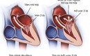 Bệnh hở van tim của Tuấn Hưng nguy hiểm ra sao?