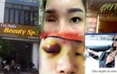 Spa Chu Huyền nói gì khi làm mù mắt cô gái trẻ tiêm filler nâng mũi?