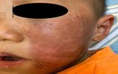 Bác sĩ cảnh báo vụ bé 4 tuổi bỏng rộp da mặt vì hóa trang Halloween