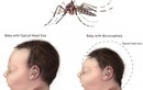 Việt Nam phát hiện ca bệnh do virus Zika, những biến chứng nguy hiểm