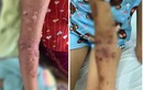 Bé gái bị bỏng nặng vì sứa “cắn”: Cách sơ cứu đúng cần biết