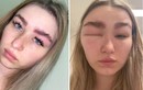 Cô gái sưng vù mặt vì duỗi lông mày: Những biến chứng đáng sợ