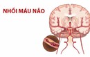 Hai vợ chồng cùng bị nhồi máu não, tất cả do thói quen này