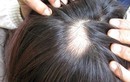 6 thói quen xấu khiến rụng tóc, hói đầu