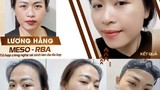 Công nghệ làm đẹp Meso-RBA đang hot tại thị trường thẩm mỹ Việt