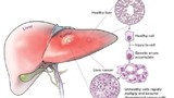 Những biểu hiện của bệnh ung thư gan 