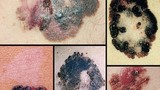 Cận cảnh sự tàn phá do ung thư da 