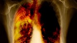 Phân biệt dấu hiệu ung thư phổi và viêm họng thông thường
