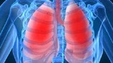 Những triệu chứng phổ biến chứng tỏ bạn bị ung thư phổi