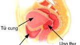 Các cách chăm sóc bệnh nhân ung thư cổ tử cung