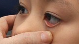 Cần điều trị sớm khi bị lác mắt