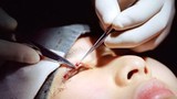 Chùm ảnh “tai nạn” khi phẫu thuật cắt mí mắt