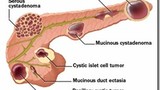 Thể giả u nang tụy là gì?