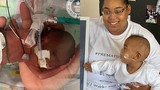 Kỳ tích sống sót của em bé sinh ra chỉ nặng 420 gram