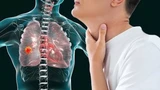 Triệu chứng “báo động đỏ” ở 70% bệnh nhân ung thư phổi