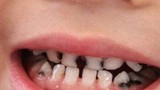Loạt thói quen khiến trẻ bị sâu răng, cha mẹ nên chú ý sớm