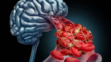 Cảnh báo 6 triệu chứng sớm của nhồi máu não