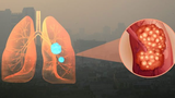 Hà Nội ô nhiễm không khí, cẩn trọng với loạt bệnh này