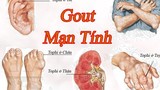 Kinh hoàng hình ảnh bệnh gout tàn phá cơ thể