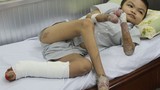 Hình ảnh cậu trai 18 tuổi trị "bệnh lạ" rụng tay chân