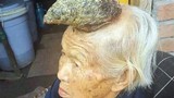 Xôn xao cụ bà 87 tuổi mọc sừng trên đầu dài 13 cm