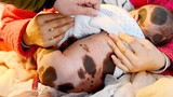 Thương tâm em bé sinh ra với vết đốm toàn cơ thể